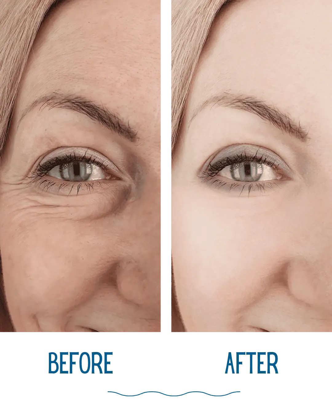 wenkbrauwlift voor en na