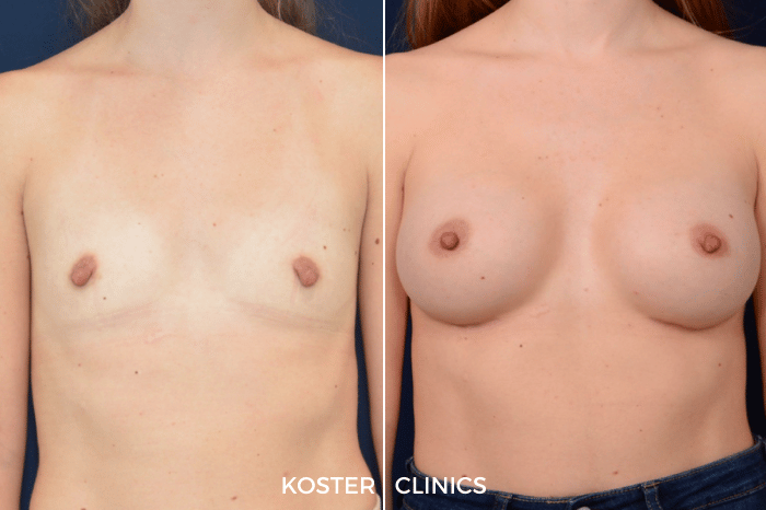 Borstvergroting voor en na