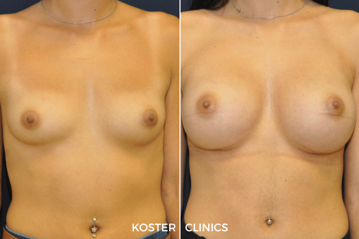Borstvergroting voor en na
