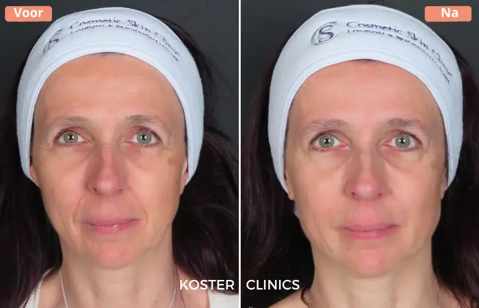 Neuslippenplooi voor en na