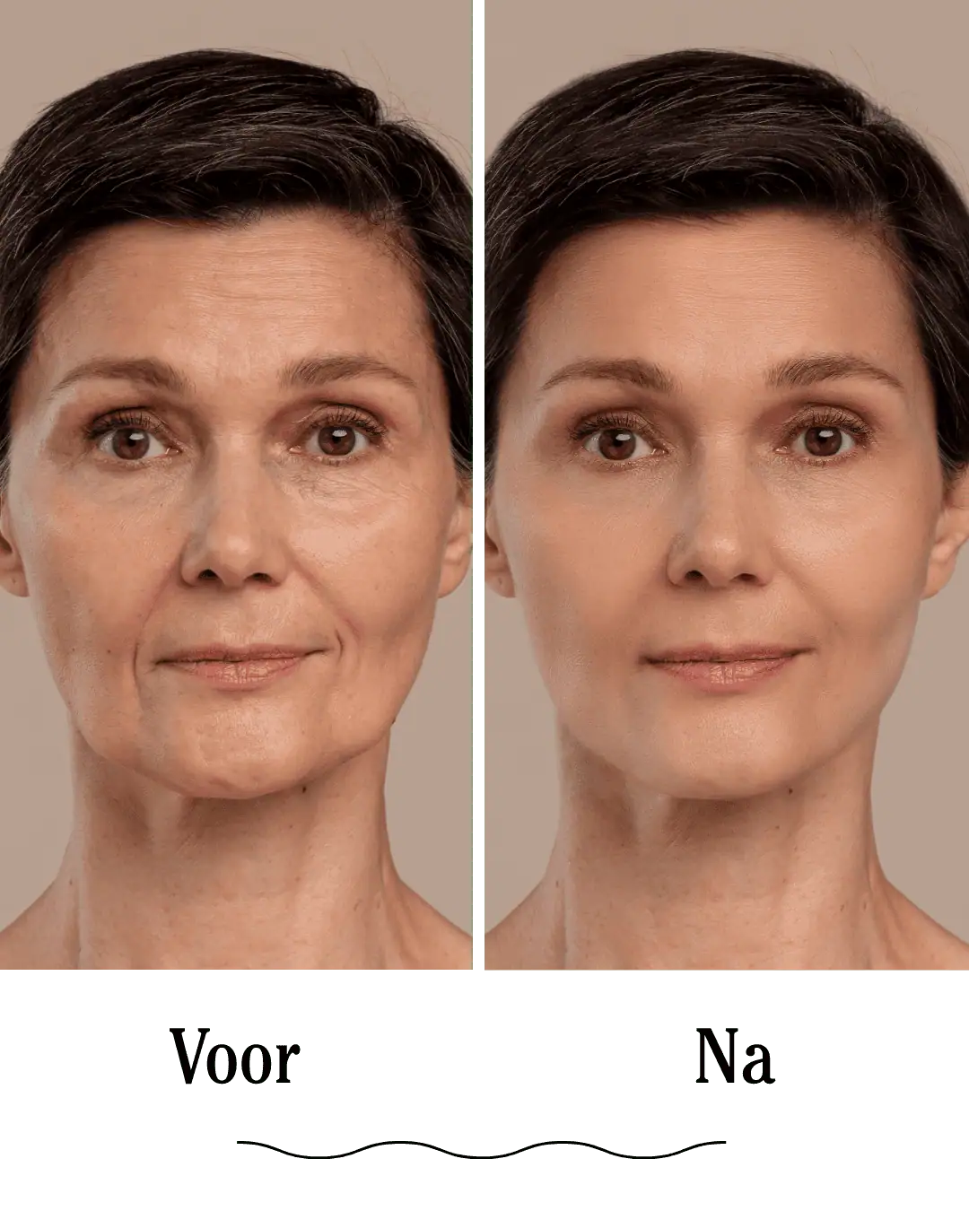 Neuslippenplooi voor en na