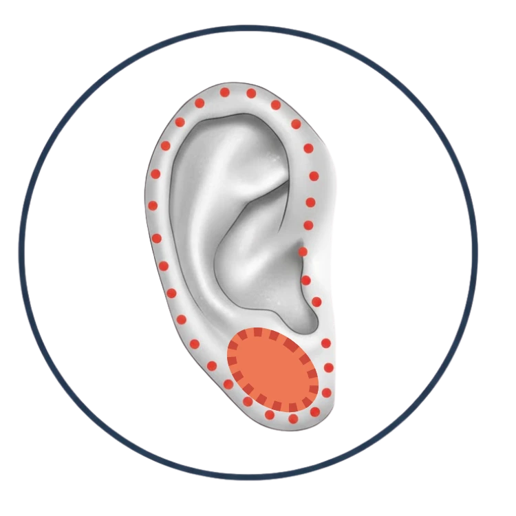 Oorlelcorrectie filler