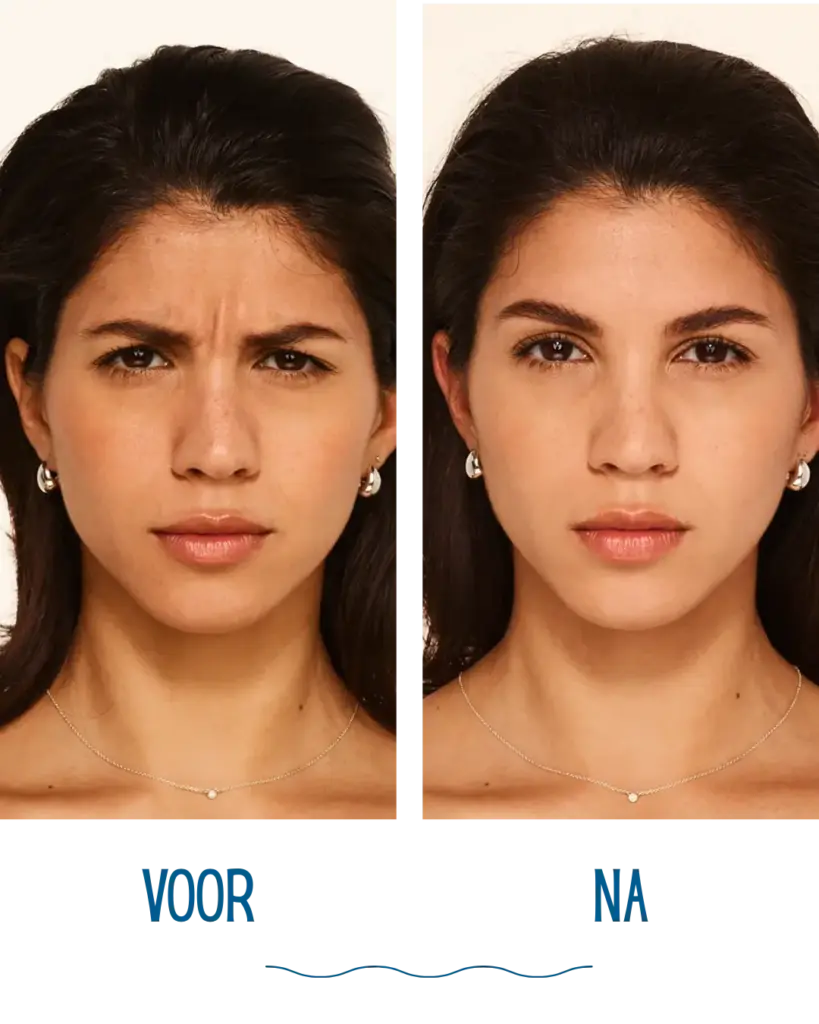 Fronsrimpel 1 fronsrimpels precies voor en na